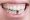 An Insight into Dental Implant Procedure and Related Requirements