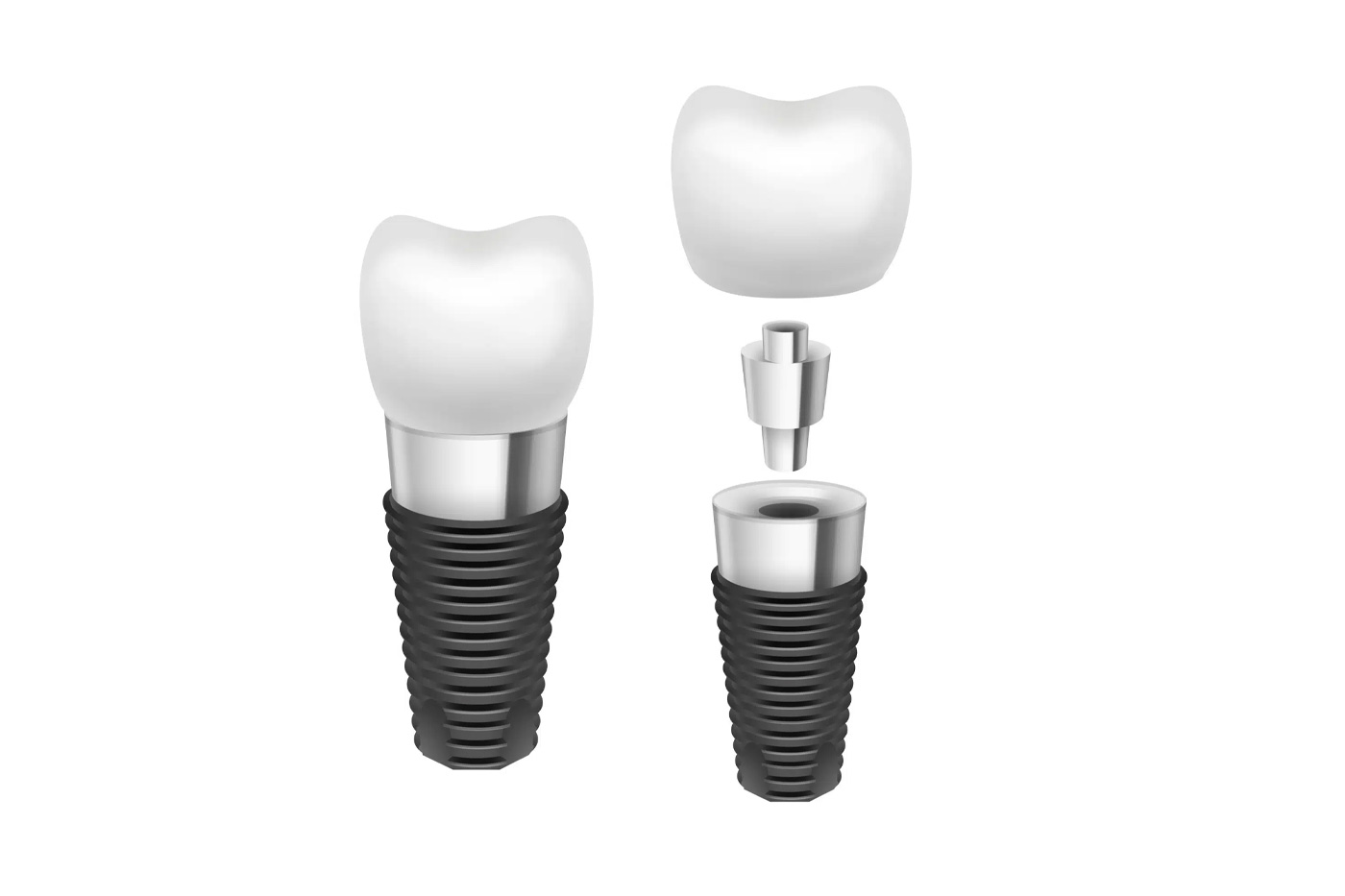 How long do dental implants last