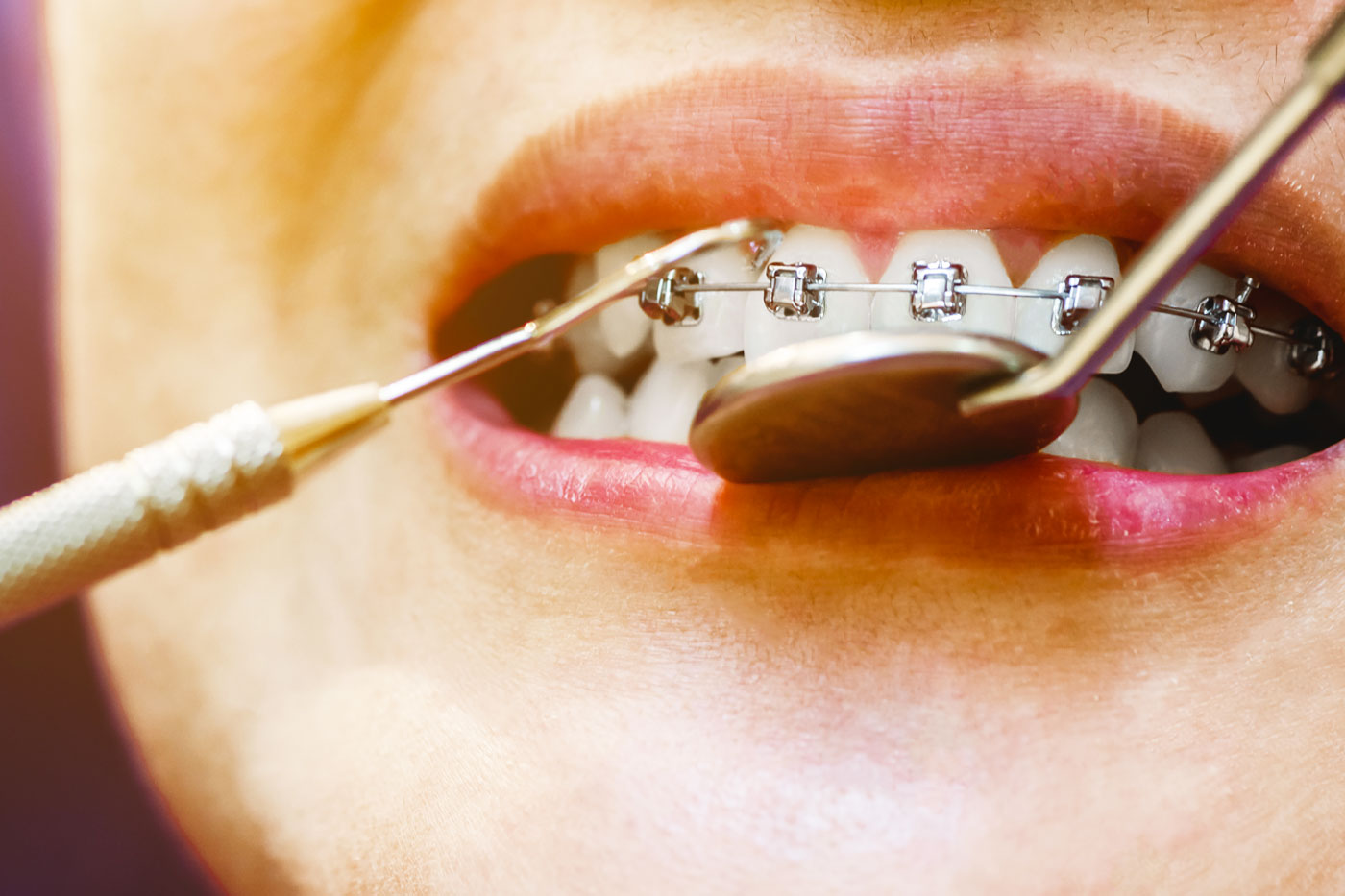 Invisalign and Braces, which one is good?