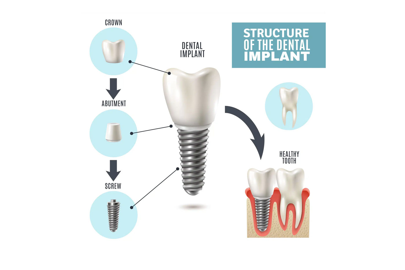 Which option is best: Dental crowns or Bridges