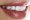 Cosmetic-Veneers​