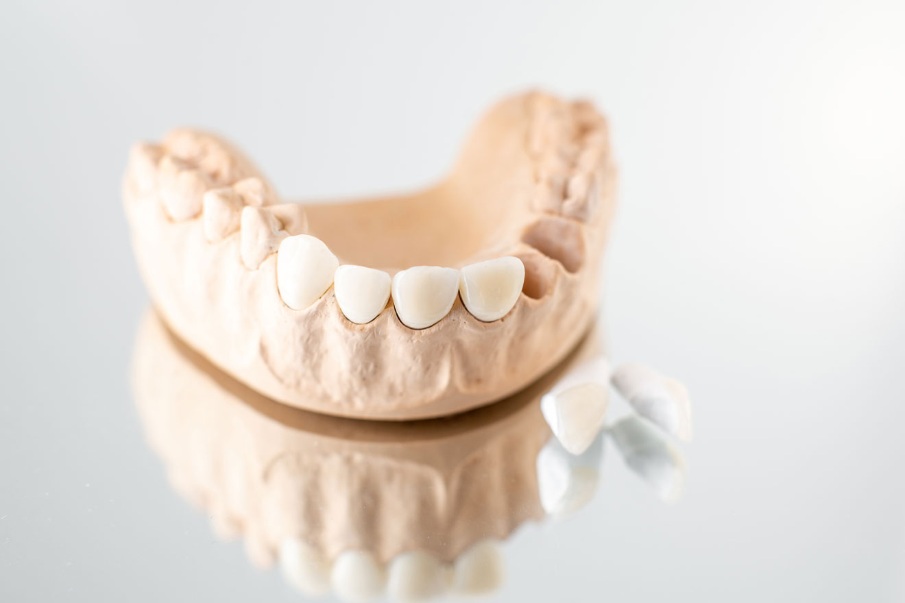 Fixed Tooth Bridge prices in Sydney
